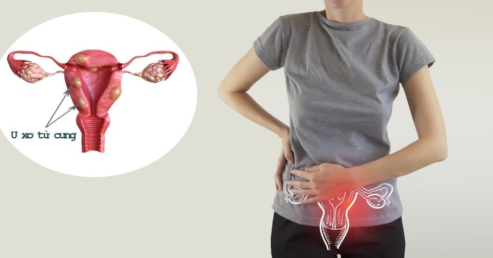 U xơ tử cung và những nguy cơ khó lường chị em cần biết - 1 U xơ tử cung và những nguy cơ khó lường chị em cần biết - 1