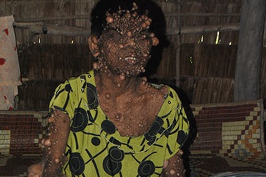 Cô gái với hàng ngàn “mụn nước” phủ khắp người 