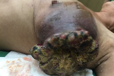 Bầu vú vỡ toạc như miệng núi lửa vì đắp thuốc nam trị ung thư