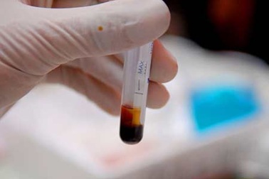 Làm sao kiểm soát được bệnh viêm gan B?