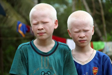 Nghị lực sống của anh em sinh đôi mang bệnh bạch tạng