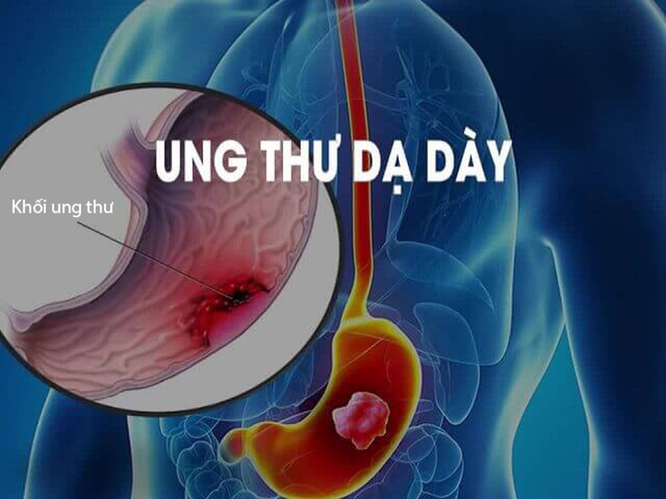 Ung thư dạ dày ngày càng gia tăng - 1