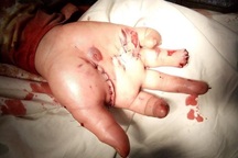 Đốt pháo tự chế, học sinh lớp 8 bị nổ nát tay