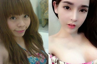 Giới trẻ Việt ngày càng “thoáng” hơn với phẫu thuật thẩm mỹ?