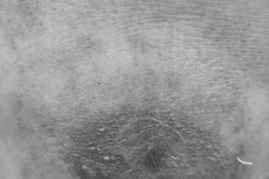 Hiểm họa từ thói quen xoa dầu nóng vào vết thương