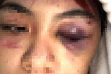 Tạm giữ hình sự nhóm đối tượng tấn công nữ sinh trong ngày tiêm vaccine