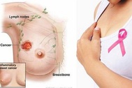 Cảnh giác hạch ở nách có thể báo hiệu ung thư vú