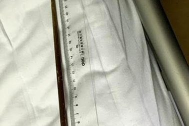 Vẫn sống sót dù nuốt đũa vào bụng suốt ba tháng