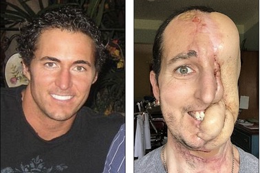 Sợ phẫu thuật, mất nửa mặt vì ung thư mô mềm