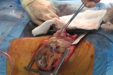 Cắt nhỏ khối u nặng gần 7kg trong lồng ngực bệnh nhân 18 tuổi