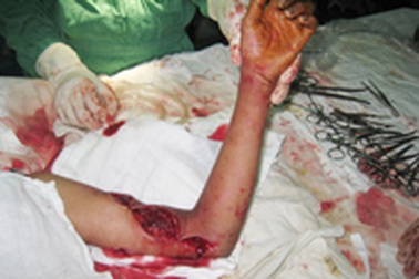 Bị máy cắt đập lúa cuốn đứt lìa cánh tay