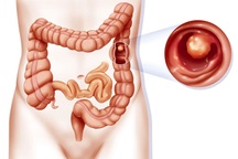 Phòng ngừa ung thư khi có polyp đại tràng như thế nào?