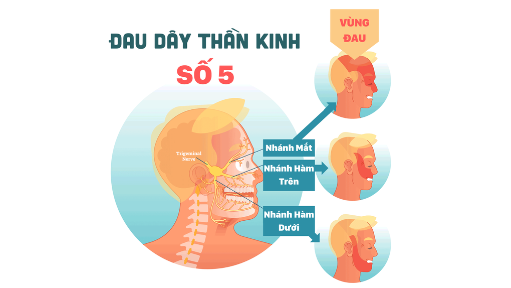 Dấu hiệu nhận biết đau dây thần kinh số 5, tránh nhầm với đau răng - 2 Dấu hiệu nhận biết đau dây thần kinh số 5, tránh nhầm với đau răng - 2