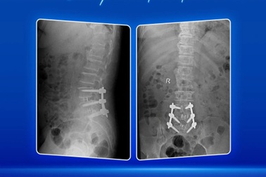 Điều trị thoát vị đĩa đệm nhiều tầng cột sống thắt lưng với công nghệ O-arm, định vị 3D