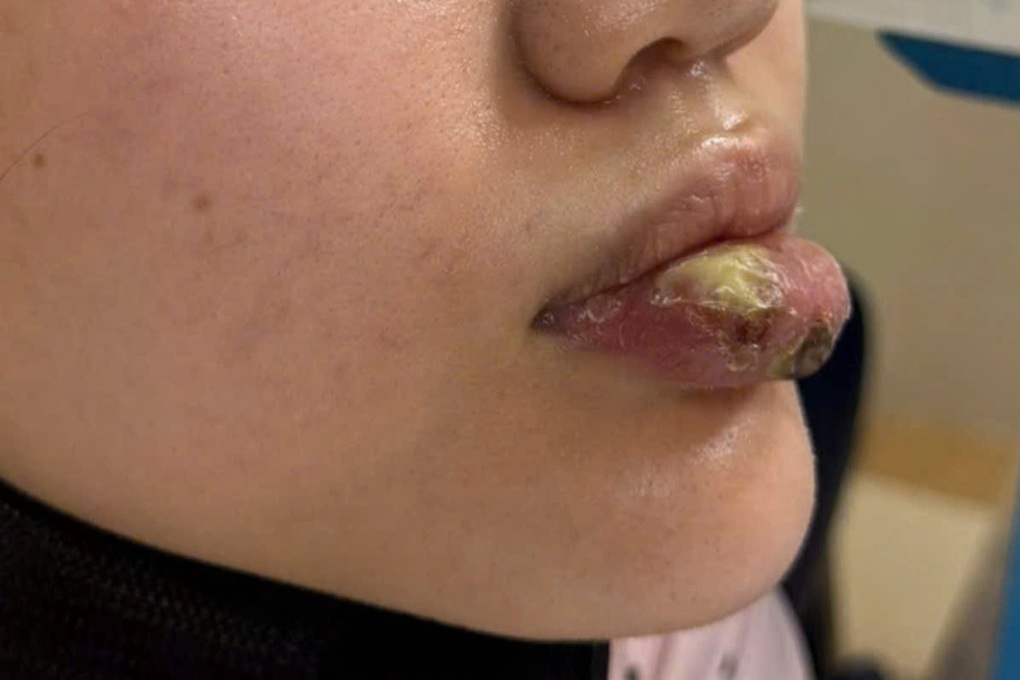 Tiêm “giải filler” tại spa không phép, cô gái trẻ bị ổ áp xe lớn ở môi - 1