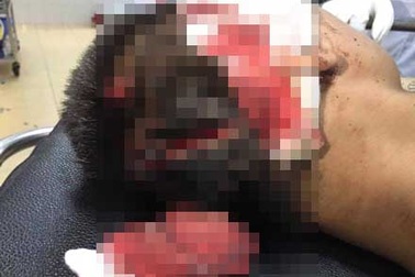 Truy tìm nhóm côn đồ vác dao chém vỡ hộp sọ nạn nhân