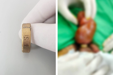 Đeo nhẫn cho "cậu nhỏ" để tìm cảm giác, nam thanh niên phải cấp cứu