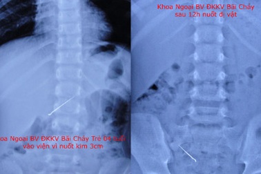 Bé 4 tuổi nuốt kim dài 3cm