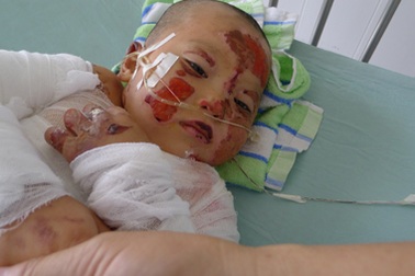 Ngã vào đống rơm đang cháy, 2 anh em bị bỏng nặng