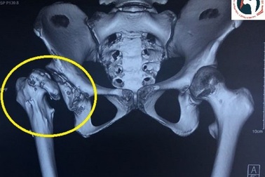 Nữ sinh lớp 9 suýt bị tàn tật vĩnh viễn vì căn bệnh tưởng chừng đơn giản