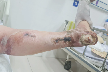 Nữ bệnh nhân phải cắt cụt chi vì biến chứng đái tháo đường