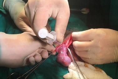 Nhiều phụ nữ “tá hỏa” vì cơ thể mang tinh hoàn của nam giới