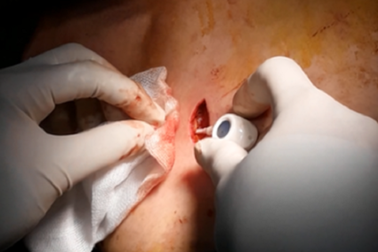 Giải pháp chống xơ cứng mạch cho bệnh nhân điều trị ung thư