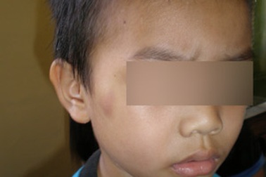 Bé trai 5 tuổi bị đánh bầm dập người