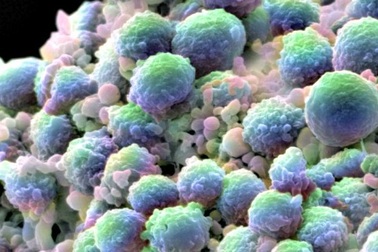 Chất béo trong dầu cọ "tiếp sức" cho ung thư di căn?