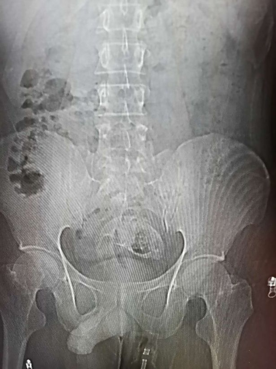 Kinh hoàng phát hiện “nguyên con cá rô phi trong bụng” - 4 Kinh hoàng phát hiện “nguyên con cá rô phi trong bụng” - 4