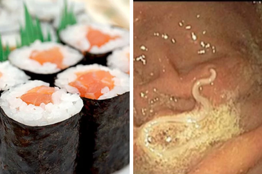 Cảnh giác với nhiễm giun chết người từ món sushi