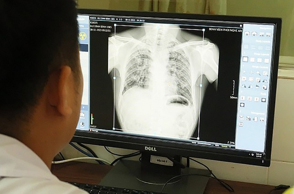 Vụ 5 công nhân tử vong vì bụi phổi: Bồi thường cao nhất 121 triệu đồng - 3