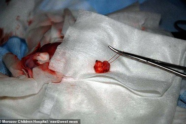 Chiếc răng mọc ở nơi không ngờ trong cơ thể cậu bé Nga