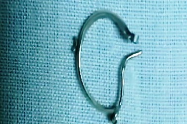 Bé gái 5 tháng tuổi nuốt khuyên tai vào thực quản