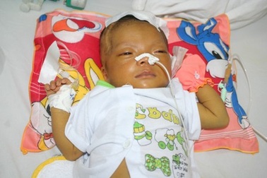 Xót xa trước bé gái 2 tháng tuổi bị liệt nửa mặt