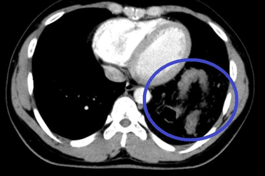 Hy hữu: Vỡ cơ hoành, đại tràng chui lên ngực vẫn tưởng hậu Covid-19
