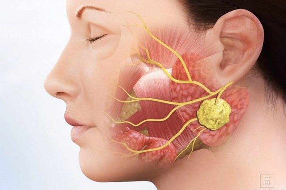 Nhận biết ung thư nước bọt có khó? - 1 Nhận biết ung thư nước bọt có khó? - 1