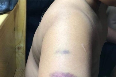 Cô giáo trường quốc tế đánh học trò bầm cánh tay