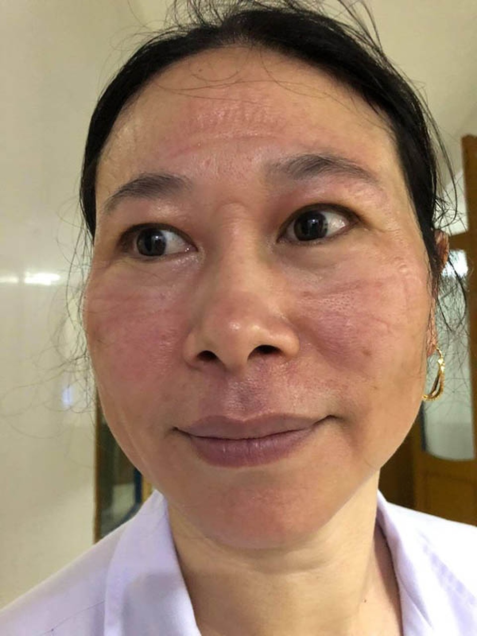 Khuôn mặt hằn vết đồ bảo hộ của nữ bác sĩ chống dịch Covid-19 - 1 Khuôn mặt hằn vết đồ bảo hộ của nữ bác sĩ chống dịch Covid-19 - 1