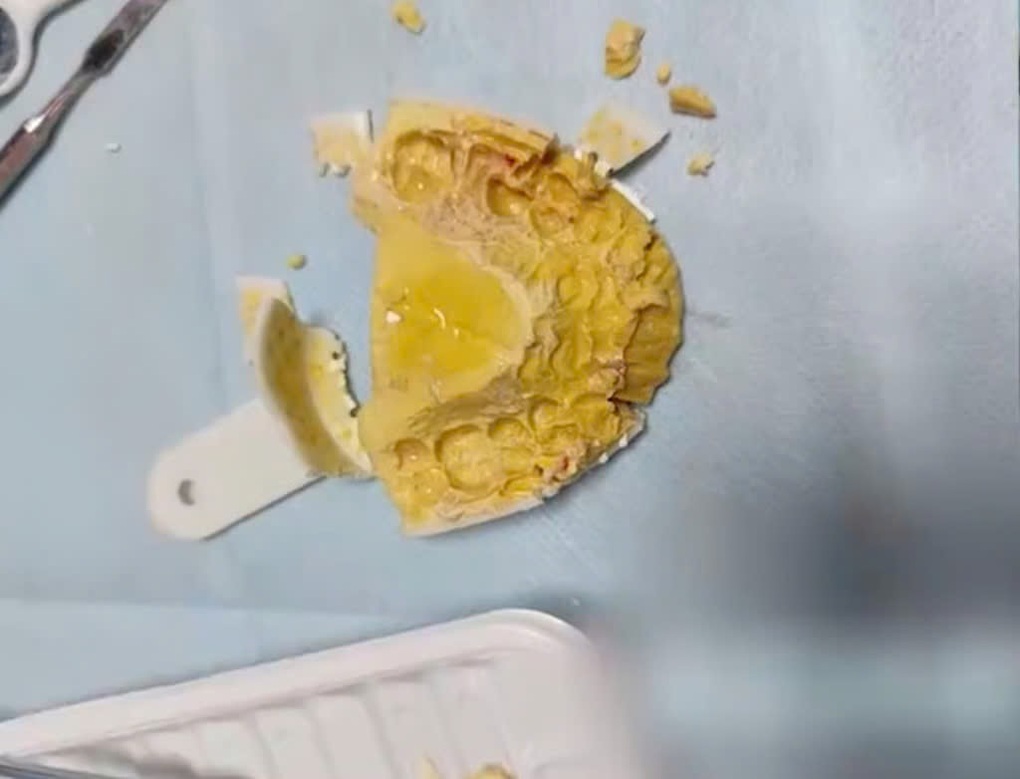 Cô gái 24 tuổi suýt ngạt vì tự làm hàm giả bằng thạch cao mua trên mạng - 2 Cô gái 24 tuổi suýt ngạt vì tự làm hàm giả bằng thạch cao mua trên mạng - 2