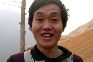 Chuyện lạ ở xứ sở… răng vàng