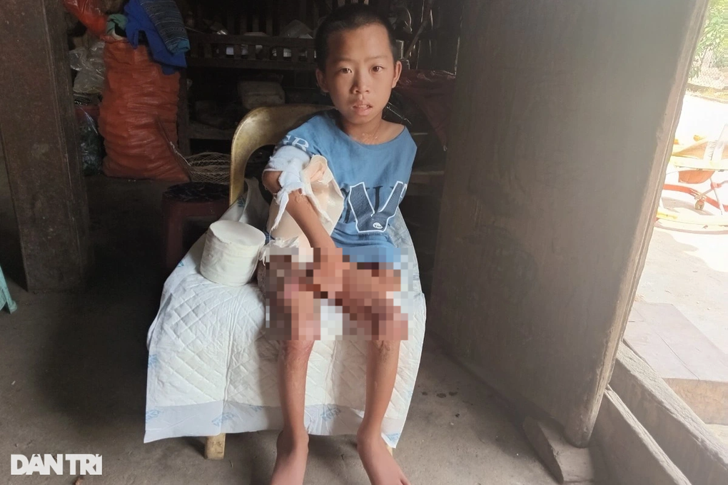 Được bạn đọc Dân trí giúp đỡ, bé trai 14 tuổi bị bỏng đã được xuất viện - 2 Được bạn đọc Dân trí giúp đỡ, bé trai 14 tuổi bị bỏng đã được xuất viện - 2