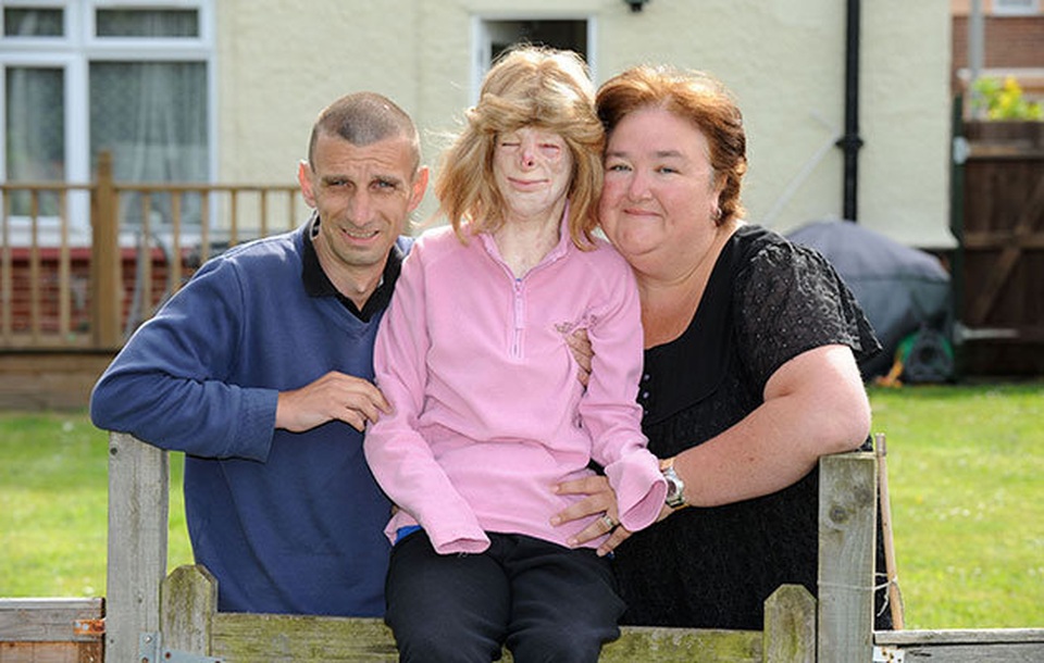 Hạnh phúc bất ngờ của cô gái từng bị bỏng đến biến dạng - 9