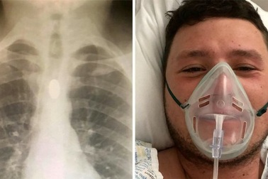 Nghịch dại, người đàn ông nuốt cả đồng xu rồi bị kẹt trong thực quản