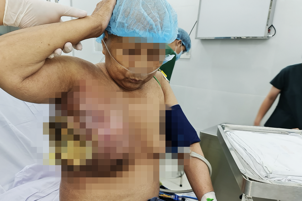 Để khối u gây đau mới đi viện, người phụ nữ bị ung thư vú hành hạ nặng nề - 1 Để khối u gây đau mới đi viện, người phụ nữ bị ung thư vú hành hạ nặng nề - 1