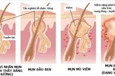 Mụn trứng cá: Cần trị cả trong lẫn ngoài