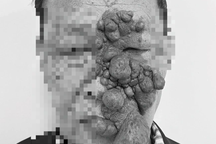 Nam bệnh nhân mang "chùm nho" khổng lồ 20 năm trên mặt