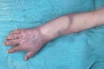 Thai phụ được ghép tạm tay đứt lìa vào chân đã thực hiện ca mổ "định mệnh"