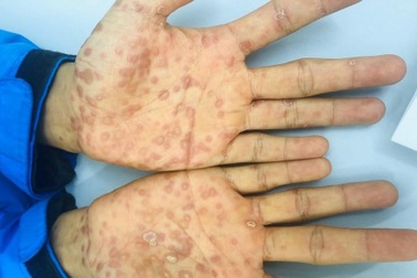 Hơn một nửa số ca mắc bệnh lây truyền qua đường tình dục xảy ra ở người trẻ