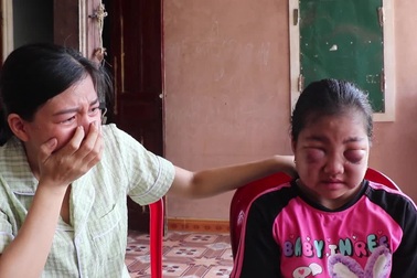 Cô bé 11 tuổi mắc bệnh lạ, mắt sưng bầm như gấu trúc